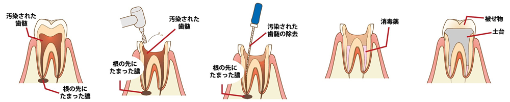 虫歯の根管治療