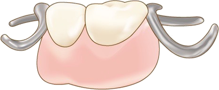 部分床義歯（部分入れ歯）